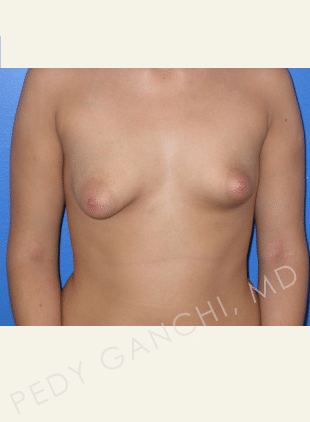 Breast Asymmetry