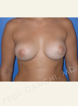 Breast Asymmetry