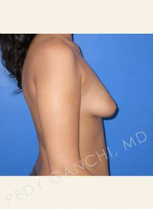 Breast Asymmetry