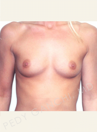 Breast Augmentation (Implants)