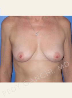 Breast Augmentation (Implants)