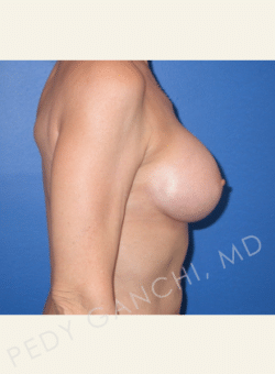 Breast Augmentation (Implants)