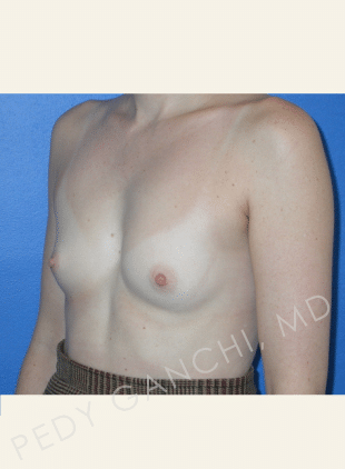 Breast Augmentation (Implants)