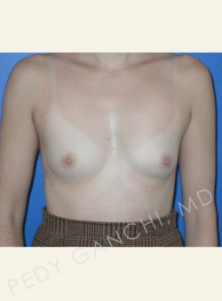 Breast Augmentation (Implants)