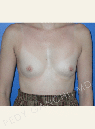 Breast Augmentation (Implants)