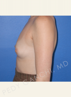 Breast Augmentation (Implants)