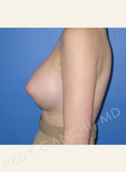 Breast Augmentation (Implants)