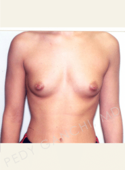 Breast Augmentation (Implants)