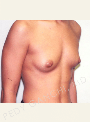 Breast Augmentation (Implants)