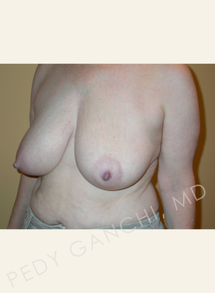 Breast Reduction (female)