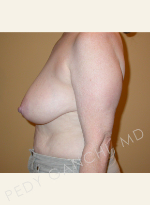 Breast Reduction (female)