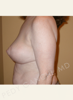 Breast Reduction (female)