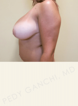 Breast Reduction (female)