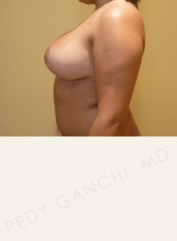 Breast Reduction (female)