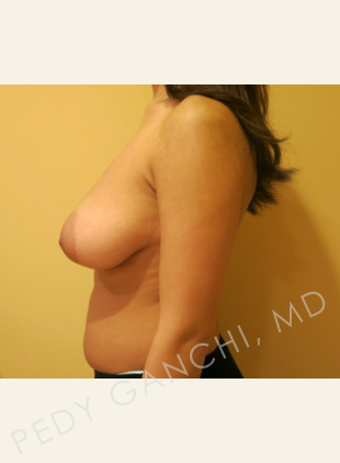 Female Breast Reduction