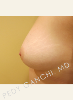 Nipple & Areola Surgery