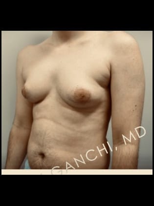 Gynecomastia (male breast reduction)