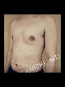 Gynecomastia (male breast reduction)