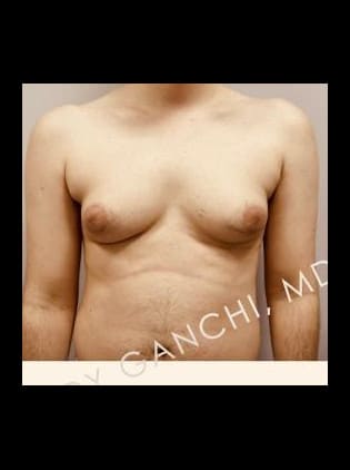 Gynecomastia (male breast reduction)