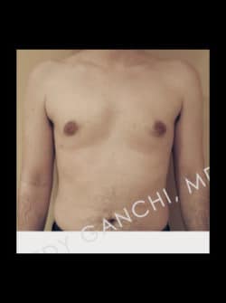 Gynecomastia (male breast reduction)