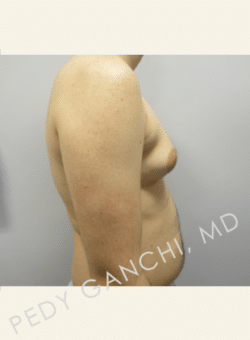 Gynecomastia (male breast reduction)