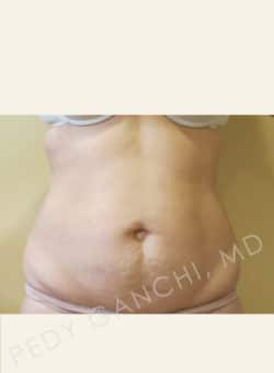 Tummy Tuck