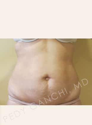 Tummy Tuck