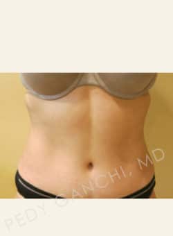 Tummy Tuck