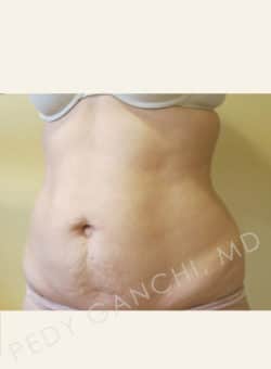 Tummy Tuck