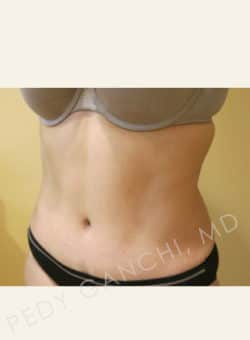 Tummy Tuck