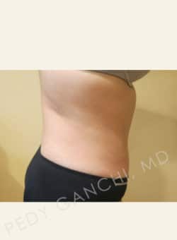 Tummy Tuck