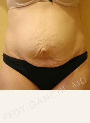 Tummy Tuck