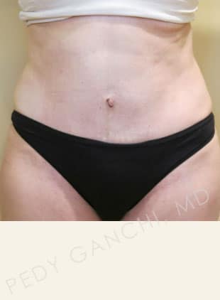 Tummy Tuck