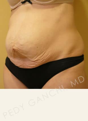 Tummy Tuck