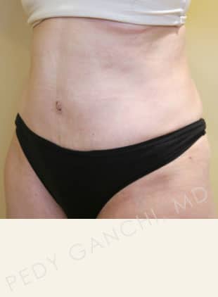 Tummy Tuck