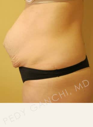 Tummy Tuck