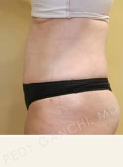 Tummy Tuck