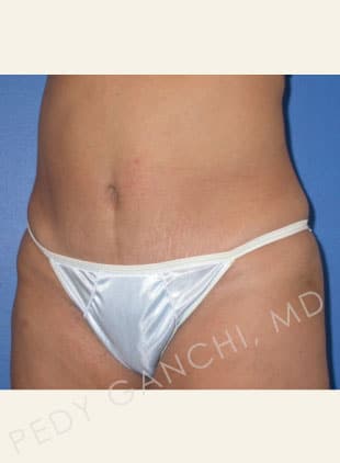 Tummy Tuck