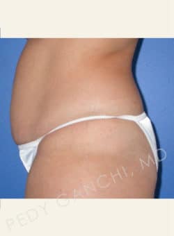 Tummy Tuck