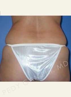 Tummy Tuck