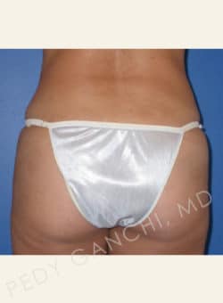 Tummy Tuck