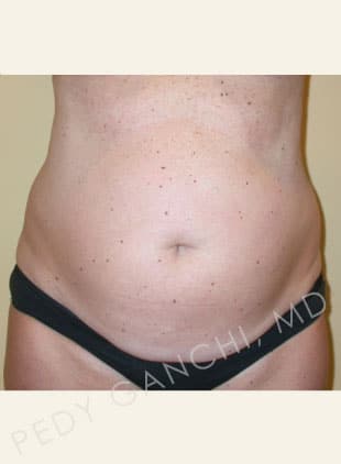 Tummy Tuck