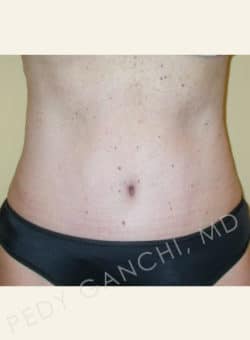 Tummy Tuck