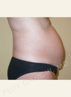 Tummy Tuck