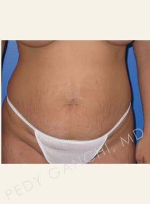 Tummy Tuck