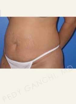 Tummy Tuck