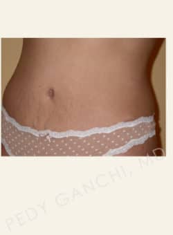 Tummy Tuck