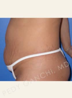 Tummy Tuck