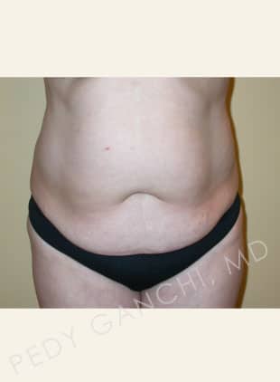 Tummy Tuck