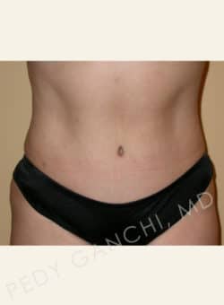 Tummy Tuck